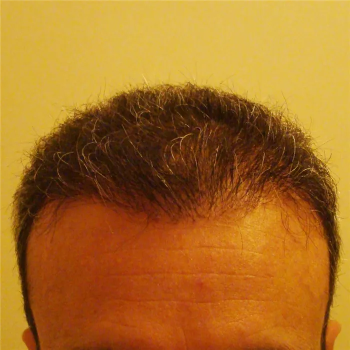 До-после пересадки волос на голову