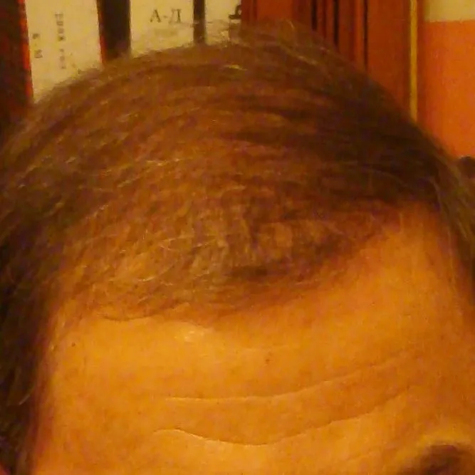 До-после пересадки волос на голову