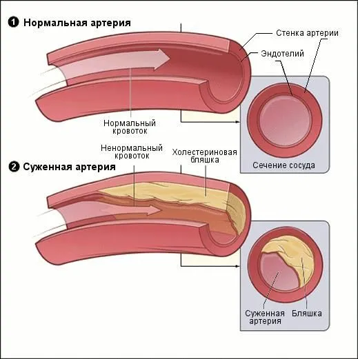 Засоренные сосуды