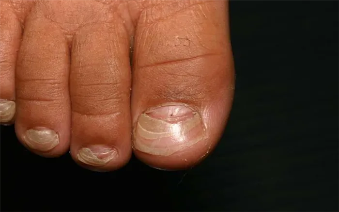 Отслойка ногтевой пластины у основания