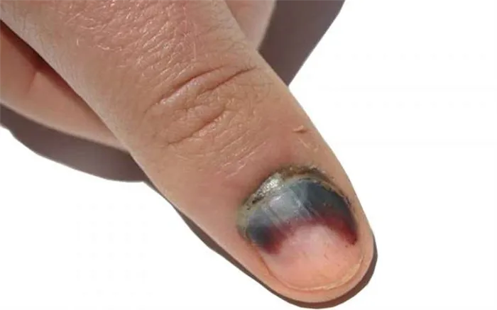 Механическое повреждение ногтевой пластины