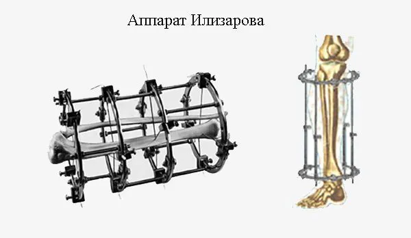 Аппарат Илизарова