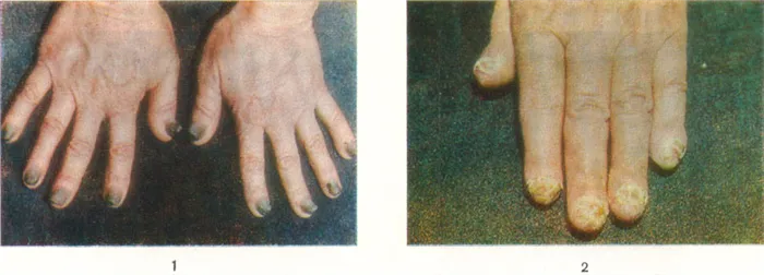 Рис. 1. Ногти рук при онихогрифозе: ногтевые пластинки резко деформированы, утолщены, цвет их изменен. Рис. 2. Ногти при псориазе: ногтевые пластинки тускнеют, становятся ломкими, свободный край утолщен и отслоен от ногтевого ложа.
