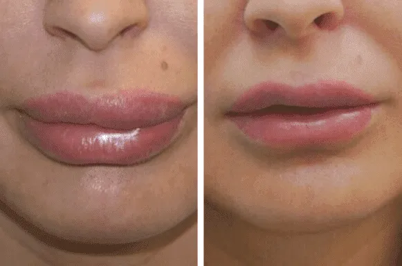 силиконовые губы фото до и после