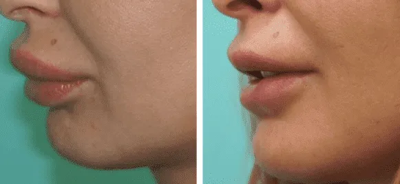 силиконовые губы фотографии