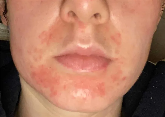 Косметический аллергико-косметический дерматит Опухшие или сухие губы