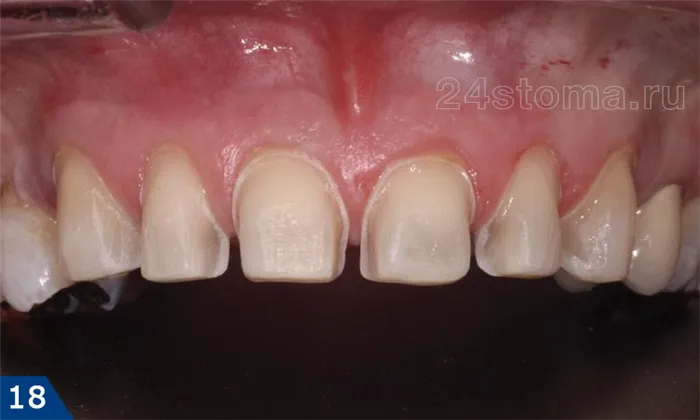Вид обточенных под виниры передних верхних зубов (обратите внимание на то, что эмаль сошлифована собразованием уступа)