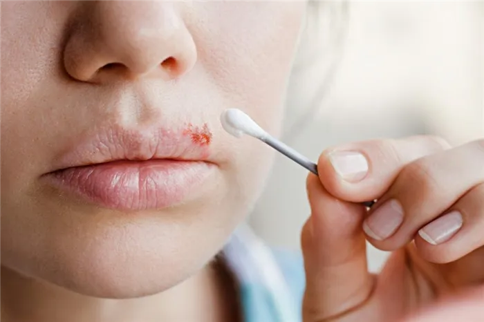 Чем лечить простуду на губах