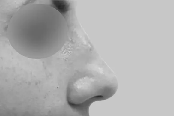 схема: коррекция носа филлерами
