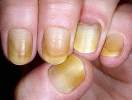 желтеют ногти на руках