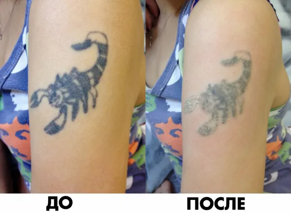 Фото до и после курса процедур по удалению татуировки лазером №1