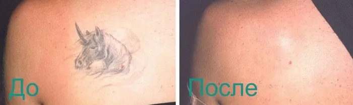 фото до и после удаления татуировки
