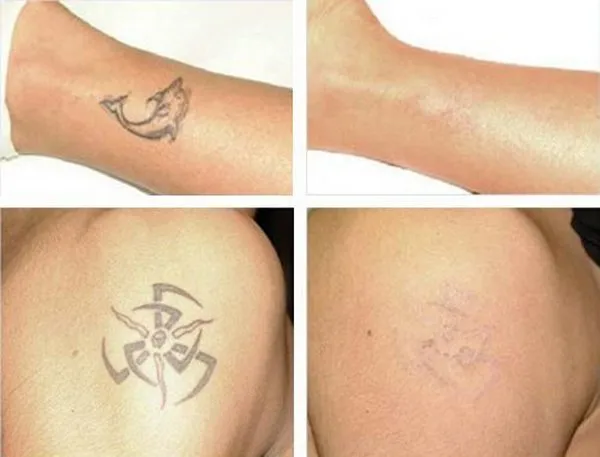 Фото до и после курса процедур по удалению татуировки лазером №2