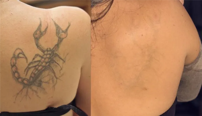 Фото до и после курса процедур по удалению татуировки лазером №3