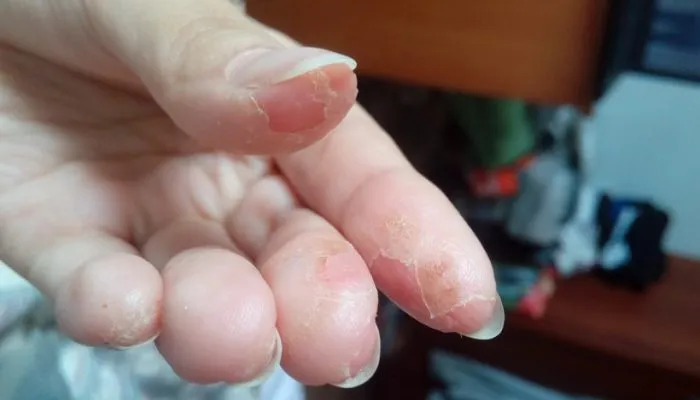 Как выглядит и лечится аллергия на шеллак? Полезные советы по использованию гель-лака для ногтей