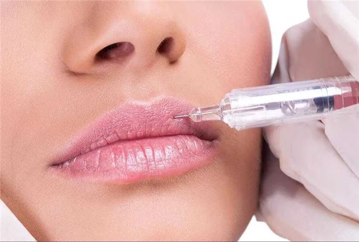 Аугментация губ препаратами на основе гиалуроновой кислоты
