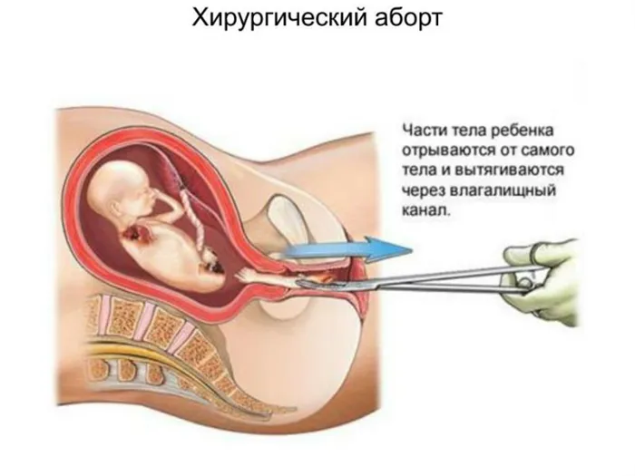 Хирургический аборт