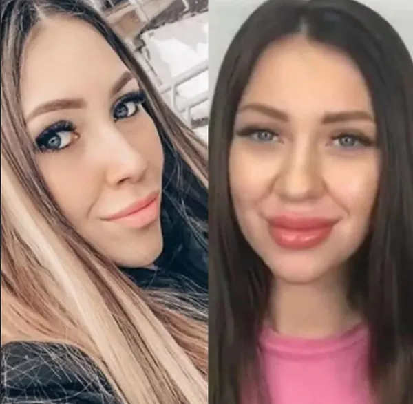Пластика Алены Рапунцель с фото до и после