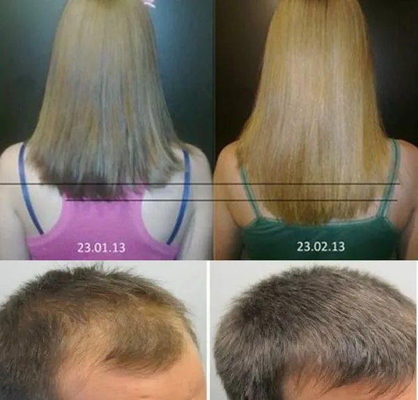 рост волос у женщин и мужчин