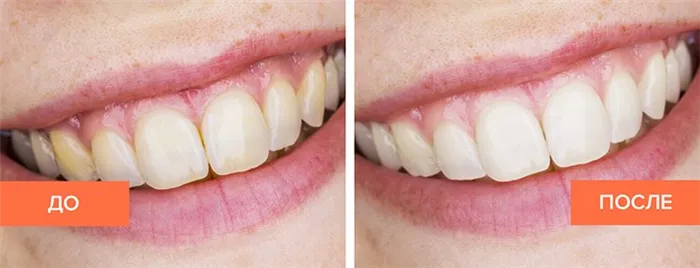 зубы после отбеливающей пасты