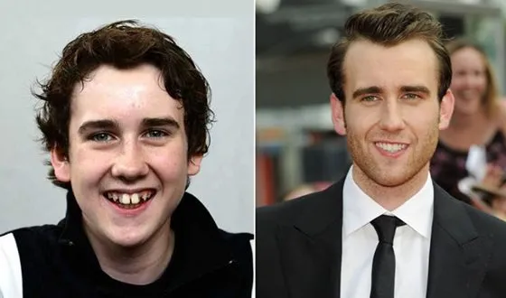 Мэттью Льюис до и после коррекции зубов
