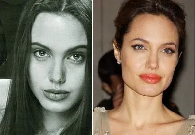 Пластика носа Анжелины Джоли