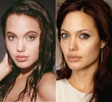 пластика губ Анжелина Джоли
