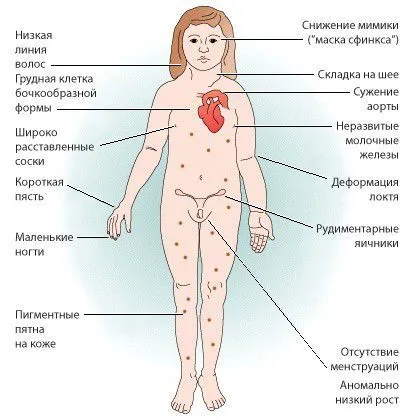 Симптомы при синдроме Шерешевского —Тёрнера
