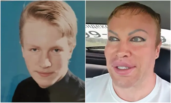 Валерий Леонтьев до и после увеличения губ