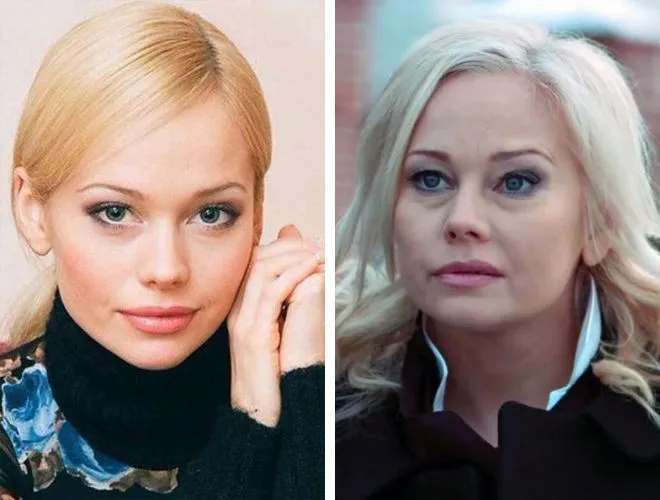 Елена Корикова до и после пластики фото