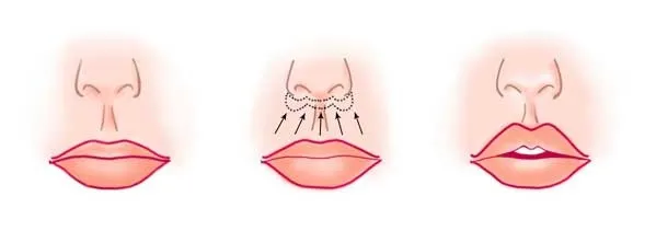 Как увеличить тонкие губы с помощью пластической хирургии (хейлопластика) 