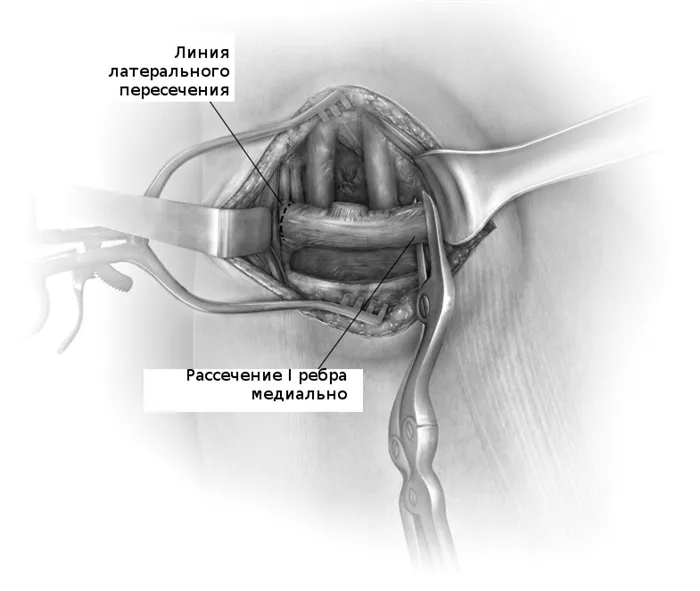 После освобождения ребра от всех окружающих мышц оно пересекается в медиальном и латеральном конце